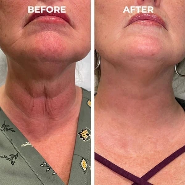 Botox ansiktsserum™