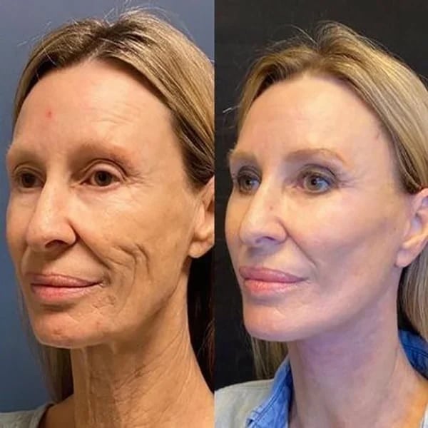 Botox ansiktsserum™