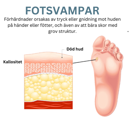 Alvobutik ™ - FootCorn Plåster för avlägsnande av förhårdnader